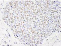 Immunohistochemistry-Paraffin: PAF1 Antibody [NB600-274] - FFPE section of human small cell lung cancer.  Affinity purified rabbit anti-Paf1 used at a dilution of 1:250.