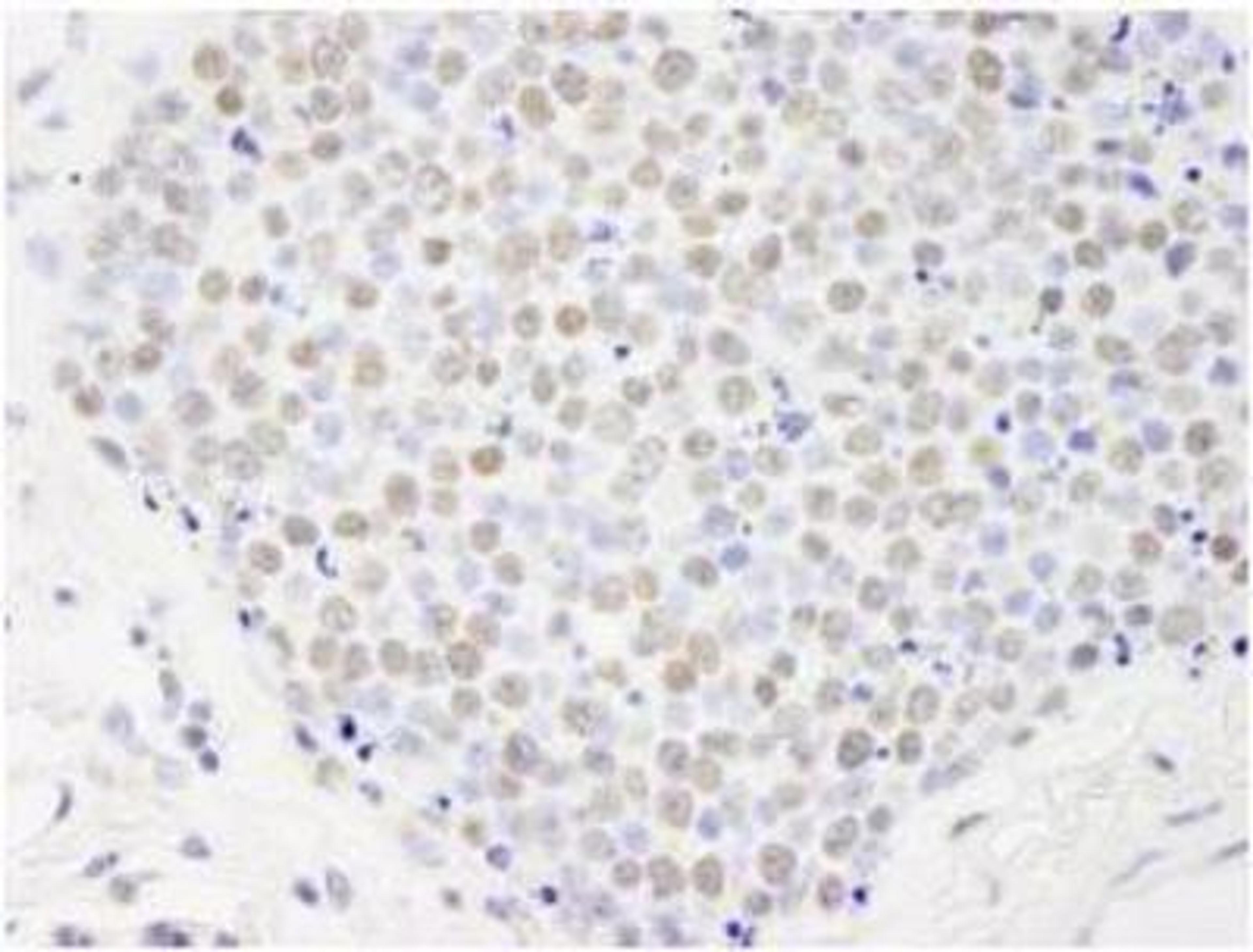 Immunohistochemistry-Paraffin: PAF1 Antibody [NB600-274] - FFPE section of human small cell lung cancer.  Affinity purified rabbit anti-Paf1 used at a dilution of 1:250.