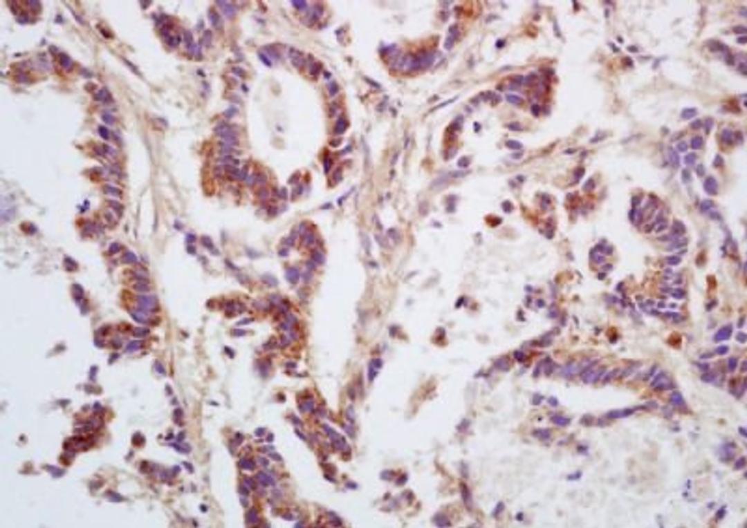 Immunohistochemical analysis of formalin-fixed paraffin embedded human gastric carcinoma tissue using G protein alpha 12 antibody (dilution at 1:200)