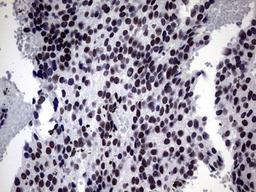 Immunohistochemistry: ZNF34 Antibody (3G2) [NBP2-46433] - Analysis of Adenocarcinoma of Human breast tissue. (Heat-induced epitope retrieval by 1 mM EDTA in 10mM Tris, pH8.5, 120C for 3min)