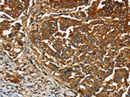 The image on the left is immunohistochemistry of paraffin-embedded Human gastic cancer tissue using CSB-PA160116(CEACAM5 Antibody) at dilution 1/20, on the right is treated with fusion protein. (Original magnification: ×200)