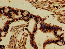 Immunohistochemistry of paraffin-embedded human pancreatic cancer using CSB-PA21119A0Rb at dilution of 1:100