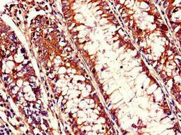 Immunohistochemistry of paraffin-embedded human colon cancer using CSB-PA618992LA01HU at dilution of 1:100