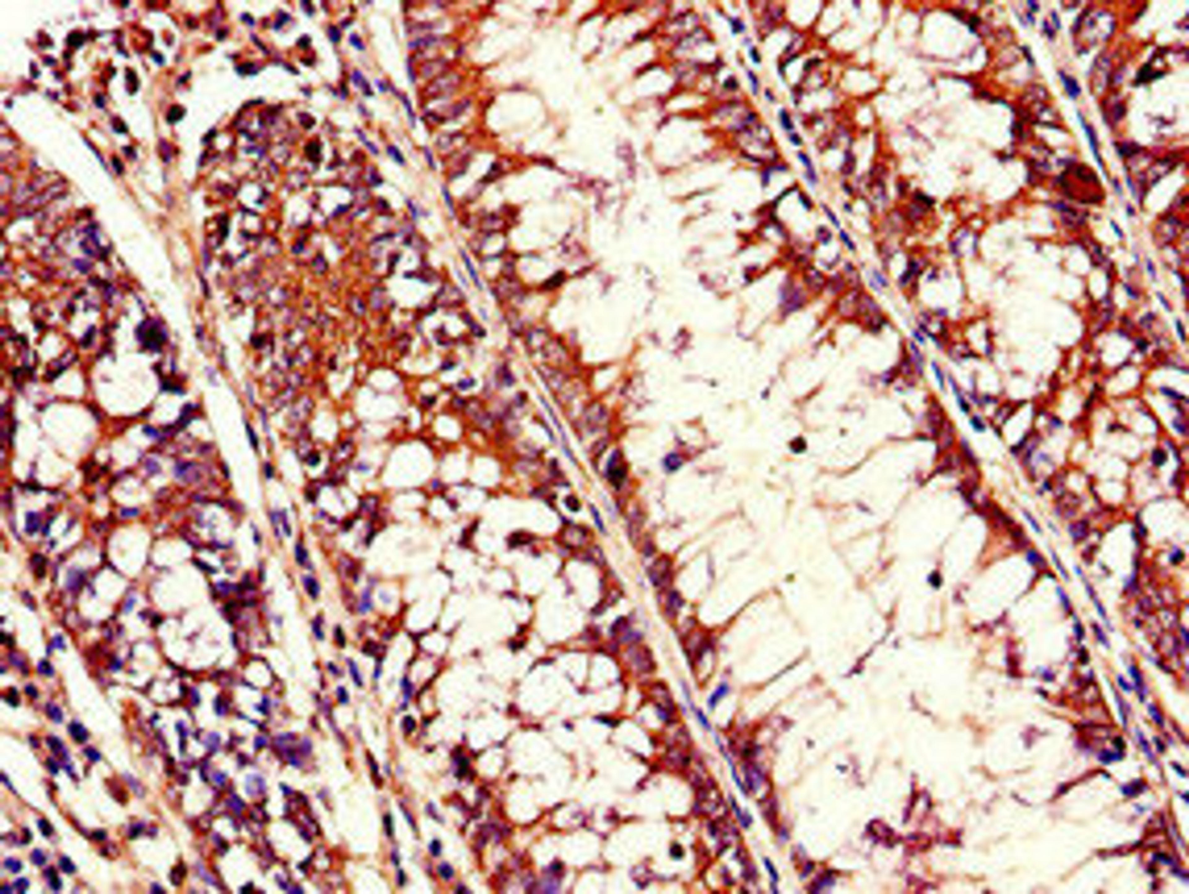 Immunohistochemistry of paraffin-embedded human colon cancer using CSB-PA618992LA01HU at dilution of 1:100
