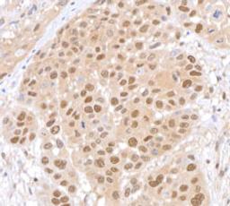 Detection of human Lasu1/Ureb1 in FFPE head & neck SCC by immunohistochemistry.