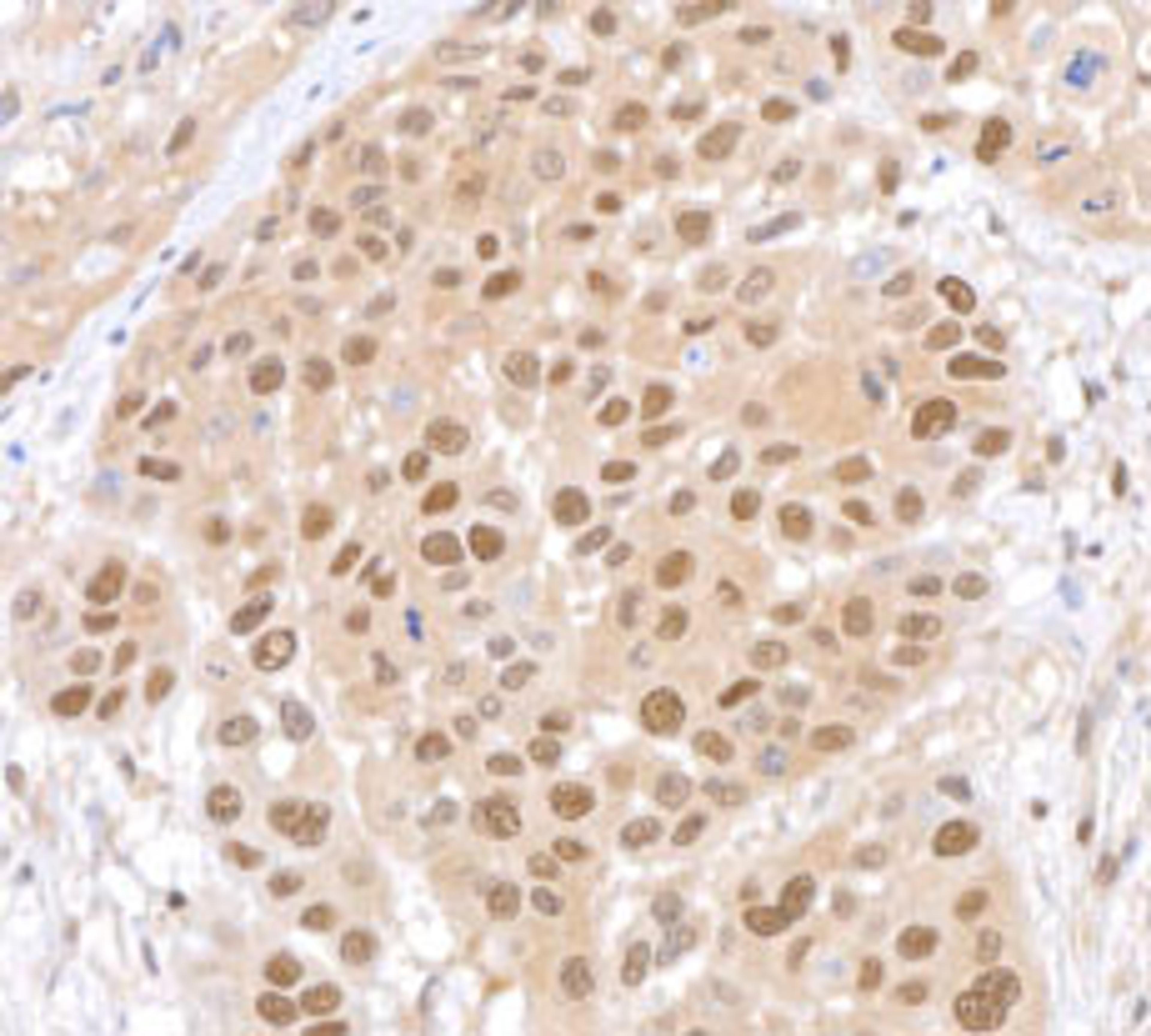 Detection of human Lasu1/Ureb1 in FFPE head & neck SCC by immunohistochemistry.