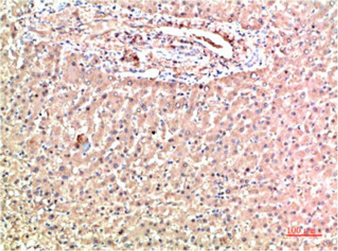 Immunohistochemical analysis of paraffin-embedded Human Liver Carcinoma Tissue using TTR Mouse mAb diluted at 1:200.