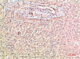 Immunohistochemical analysis of paraffin-embedded Human Liver Carcinoma Tissue using TTR Mouse mAb diluted at 1:200.