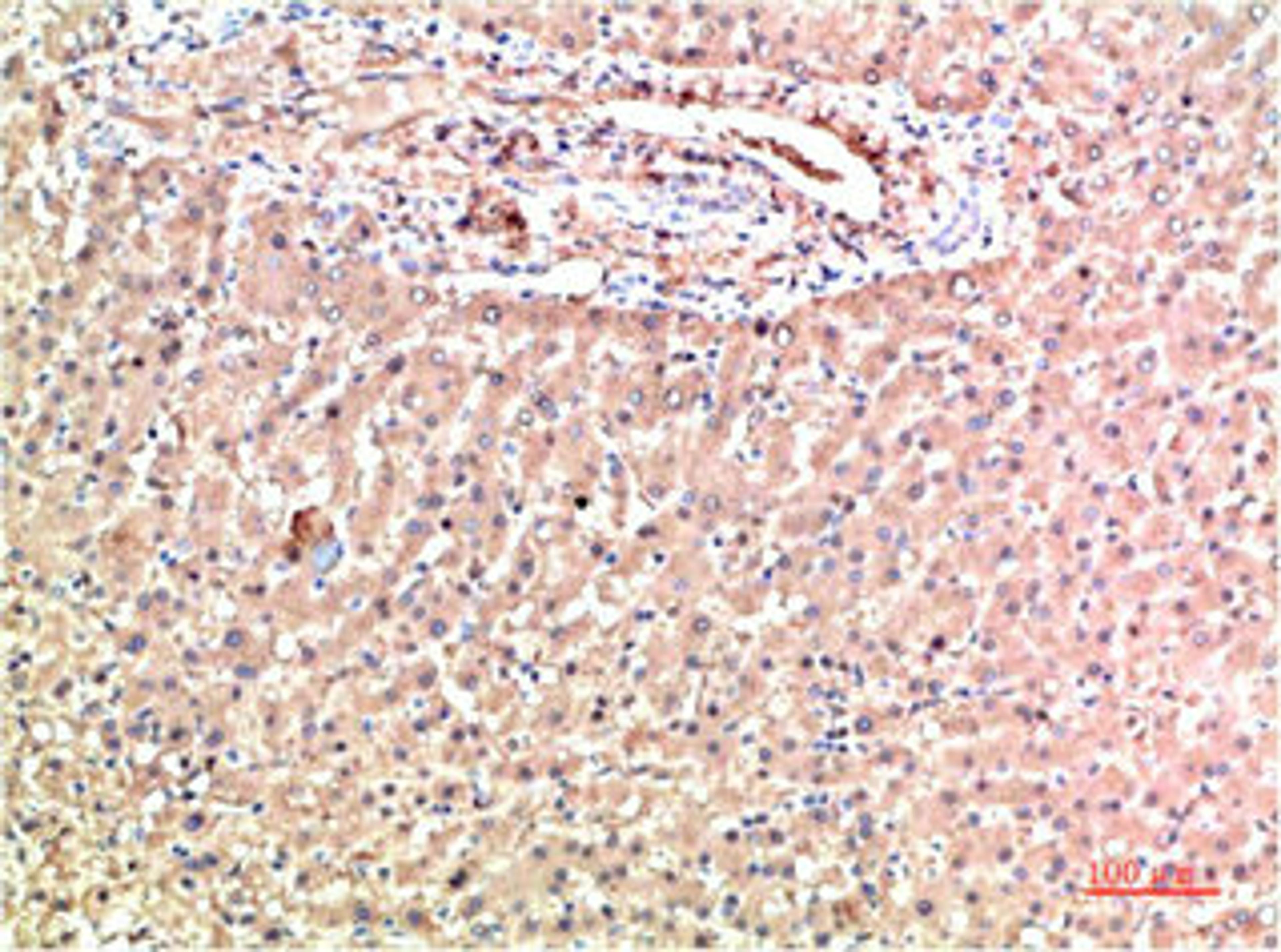 Immunohistochemical analysis of paraffin-embedded Human Liver Carcinoma Tissue using TTR Mouse mAb diluted at 1:200.