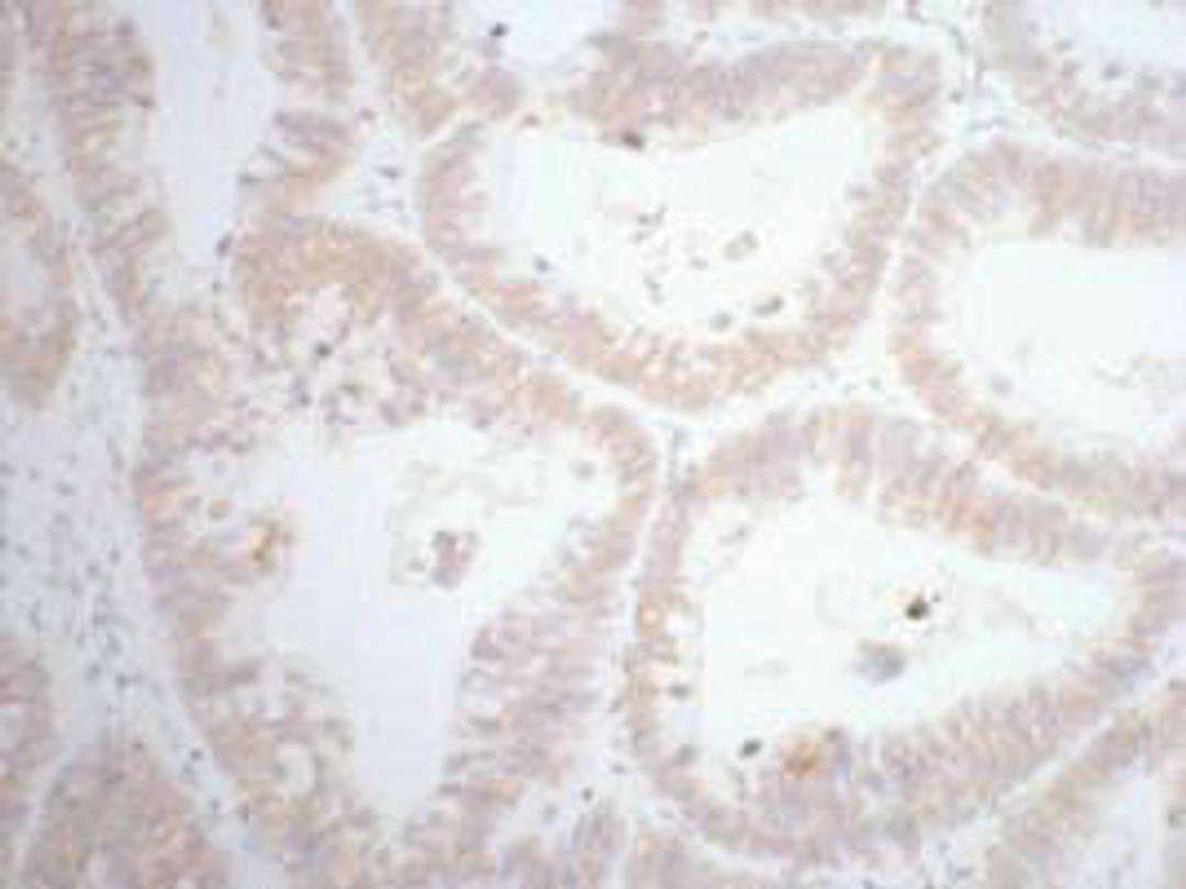 IHC staining of human rectal cancer tissue, diluted at 1:200.