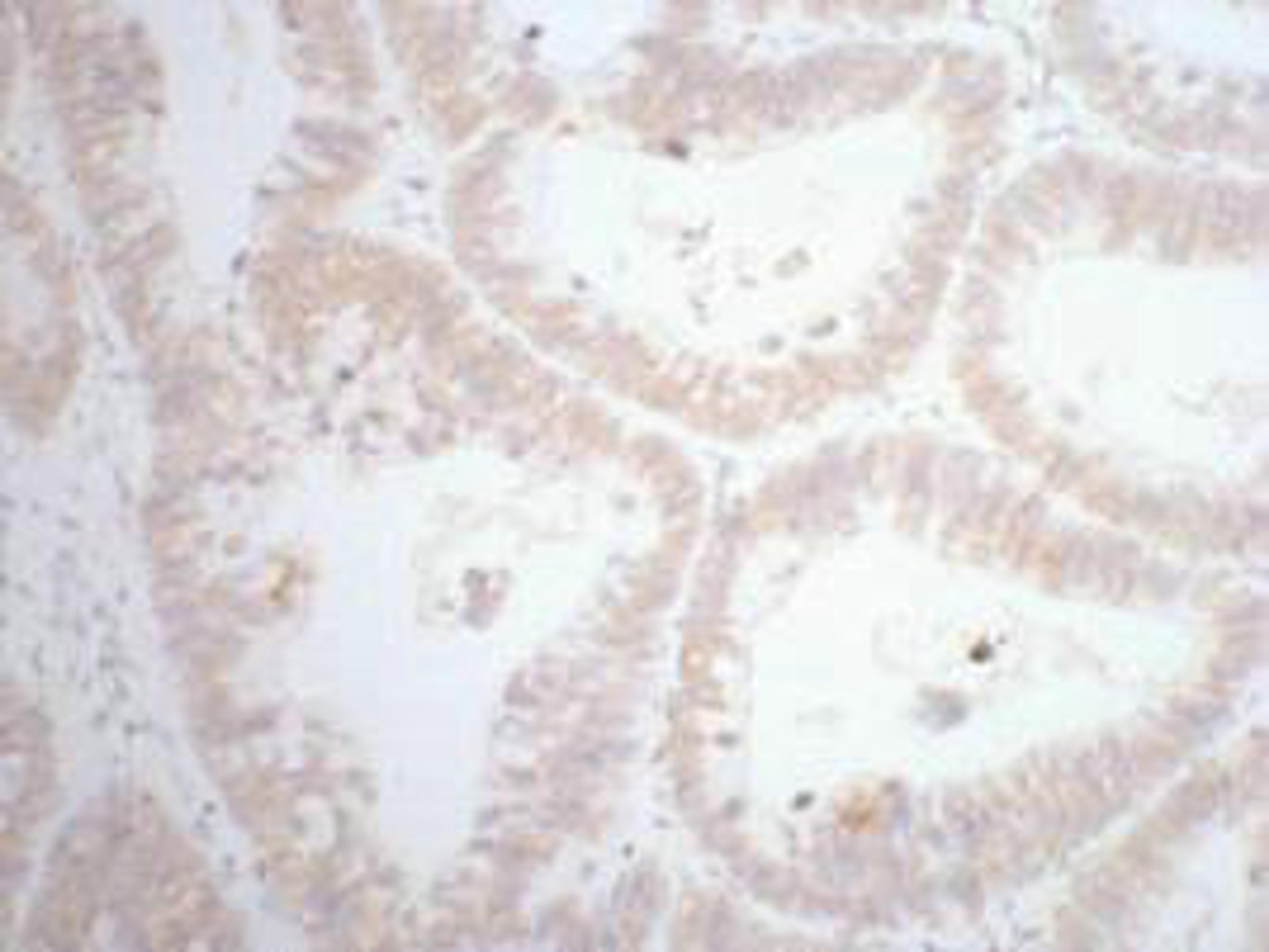IHC staining of human rectal cancer tissue, diluted at 1:200.