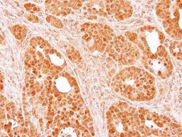 Immunohistochemistry-Paraffin: SMYD5 Antibody [NBP1-31222] - Paraffin-embedded NCI-N87 xenograft, using antibody at 1:100 dilution.