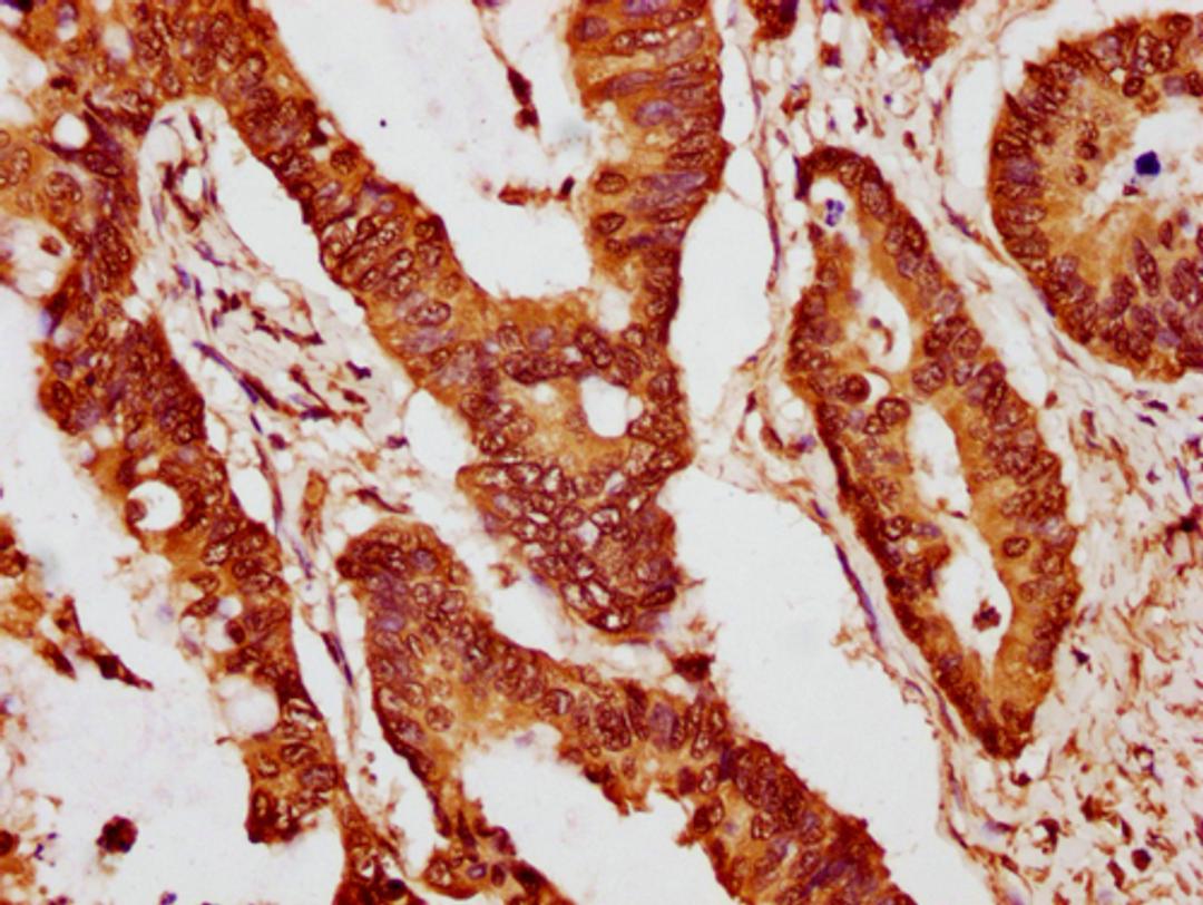 IHC image of CSB-PA010403PA15nme1HU diluted at 1:10 and staining in paraffin-embedded human colon cancer performed on a Leica BondTM system. After dewaxing and hydration, antigen retrieval was mediated by high pressure in a citrate buffer (pH 6.0). Section was blocked with 10% normal goat serum 30min at RT. Then primary antibody (1% BSA) was incubated at 4°C overnight. The primary is detected by a biotinylated secondary antibody and visualized using an HRP conjugated SP system.