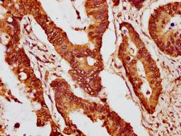 IHC image of CSB-PA010403PA15nme1HU diluted at 1:10 and staining in paraffin-embedded human colon cancer performed on a Leica BondTM system. After dewaxing and hydration, antigen retrieval was mediated by high pressure in a citrate buffer (pH 6.0). Section was blocked with 10% normal goat serum 30min at RT. Then primary antibody (1% BSA) was incubated at 4°C overnight. The primary is detected by a biotinylated secondary antibody and visualized using an HRP conjugated SP system.
