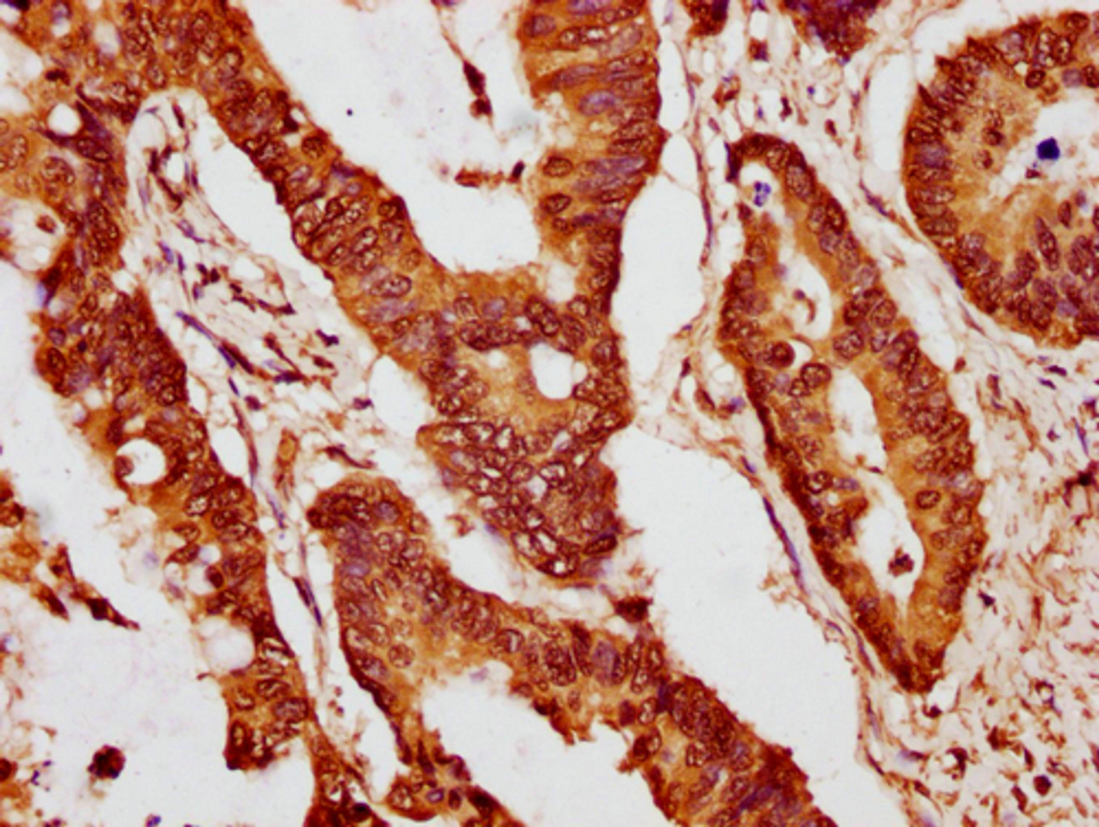 IHC image of CSB-PA010403PA15nme1HU diluted at 1:10 and staining in paraffin-embedded human colon cancer performed on a Leica BondTM system. After dewaxing and hydration, antigen retrieval was mediated by high pressure in a citrate buffer (pH 6.0). Section was blocked with 10% normal goat serum 30min at RT. Then primary antibody (1% BSA) was incubated at 4°C overnight. The primary is detected by a biotinylated secondary antibody and visualized using an HRP conjugated SP system.