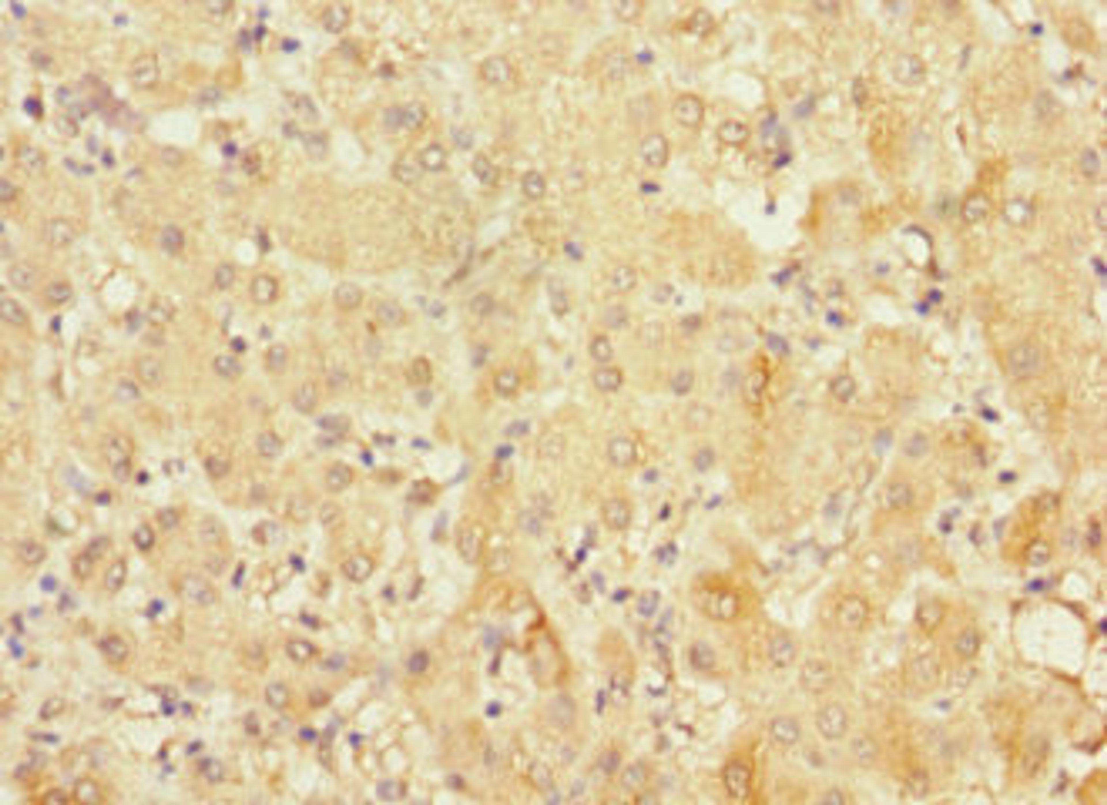 Immunohistochemistry of paraffin-embedded human liver cancer using CSB-PA822270ESR2HU at dilution of 1:100