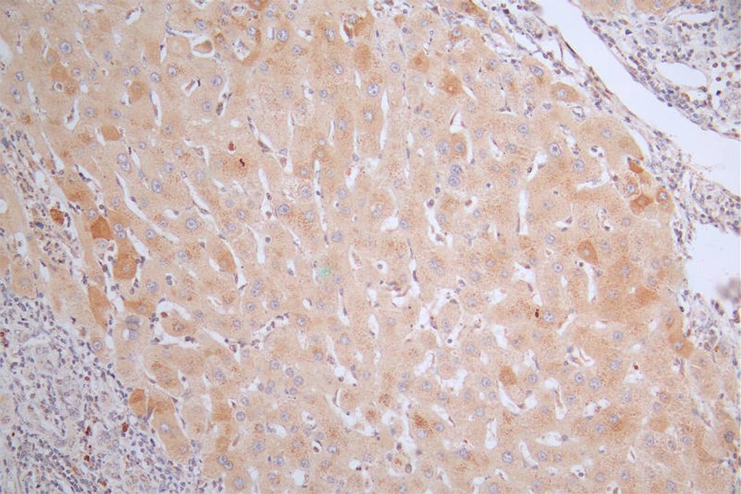 IHC image of CSB-RA988767A0HU diluted at 1:50 and staining in paraffin-embedded human liver cancer performed on a Leica BondTM system. After dewaxing and hydration, antigen retrieval was mediated by high pressure in a citrate buffer (pH 6.0). Section was blocked with 10% normal goat serum 30min at RT. Then primary antibody (1% BSA) was incubated at 4°C overnight. The primary is detected by a Goat anti-rabbit polymer IgG labeled by HRP and visualized using 0.38% DAB.