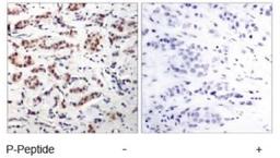 Immunohistochemistry: STAT5a [p Tyr694] Antibody [NB100-82219] - STAT5A [p Tyr694] Antibody [NB100-82219] - Immunohistochemical analysis of paraffin-embedded human breast carcinoma tissue.