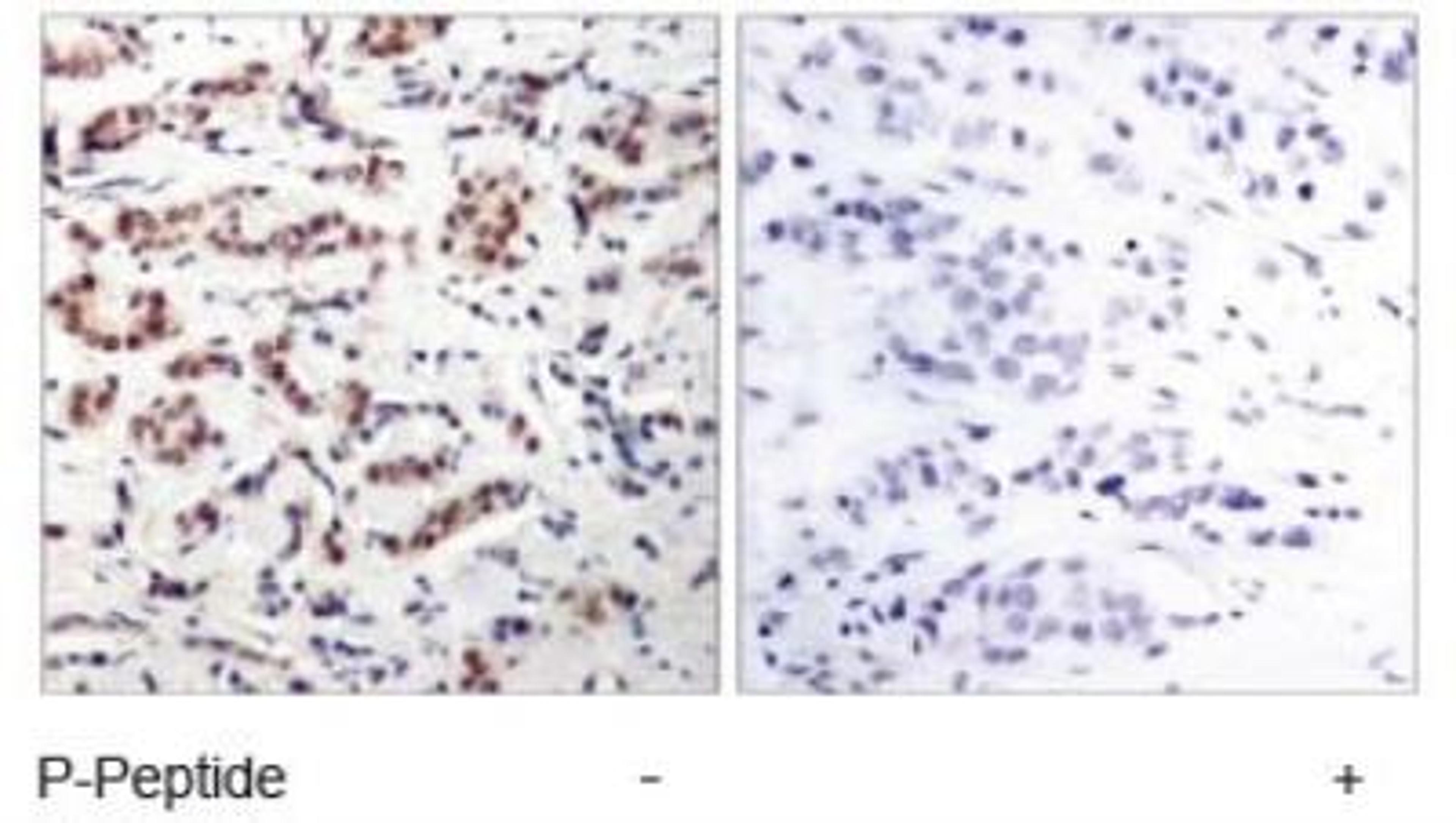 Immunohistochemistry: STAT5a [p Tyr694] Antibody [NB100-82219] - STAT5A [p Tyr694] Antibody [NB100-82219] - Immunohistochemical analysis of paraffin-embedded human breast carcinoma tissue.