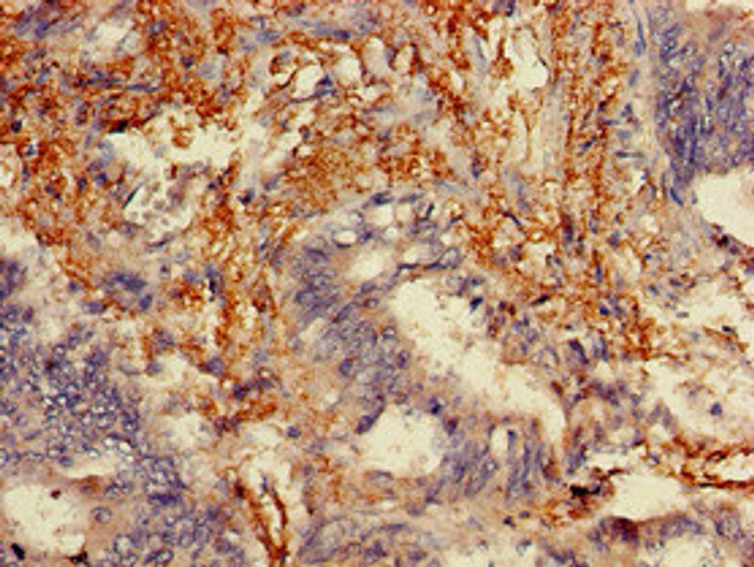 Immunohistochemistry of paraffin-embedded human colon cancer using CSB-PA014640LA01HU at dilution of 1:100