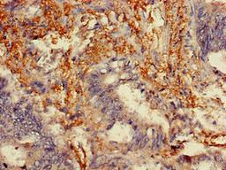 Immunohistochemistry of paraffin-embedded human colon cancer using CSB-PA014640LA01HU at dilution of 1:100