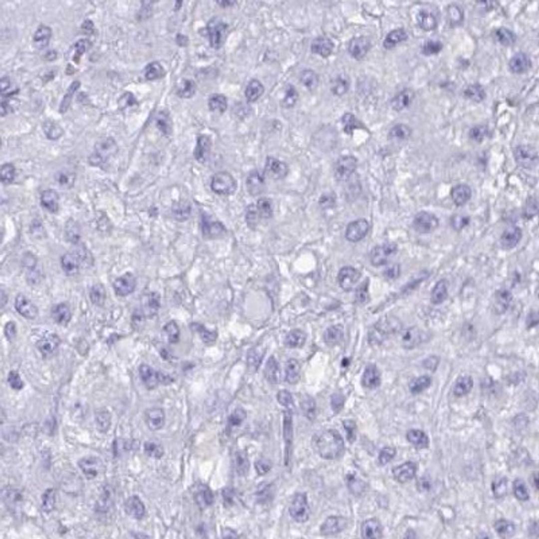 Immunohistochemistry: MRGPRG Antibody [NBP2-32405] - liver cancer