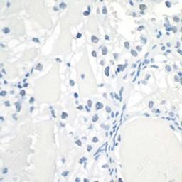 Detection of human Hif1-alpha in FFPE clear cell renal cell carcinoma by immunohistochemistry.