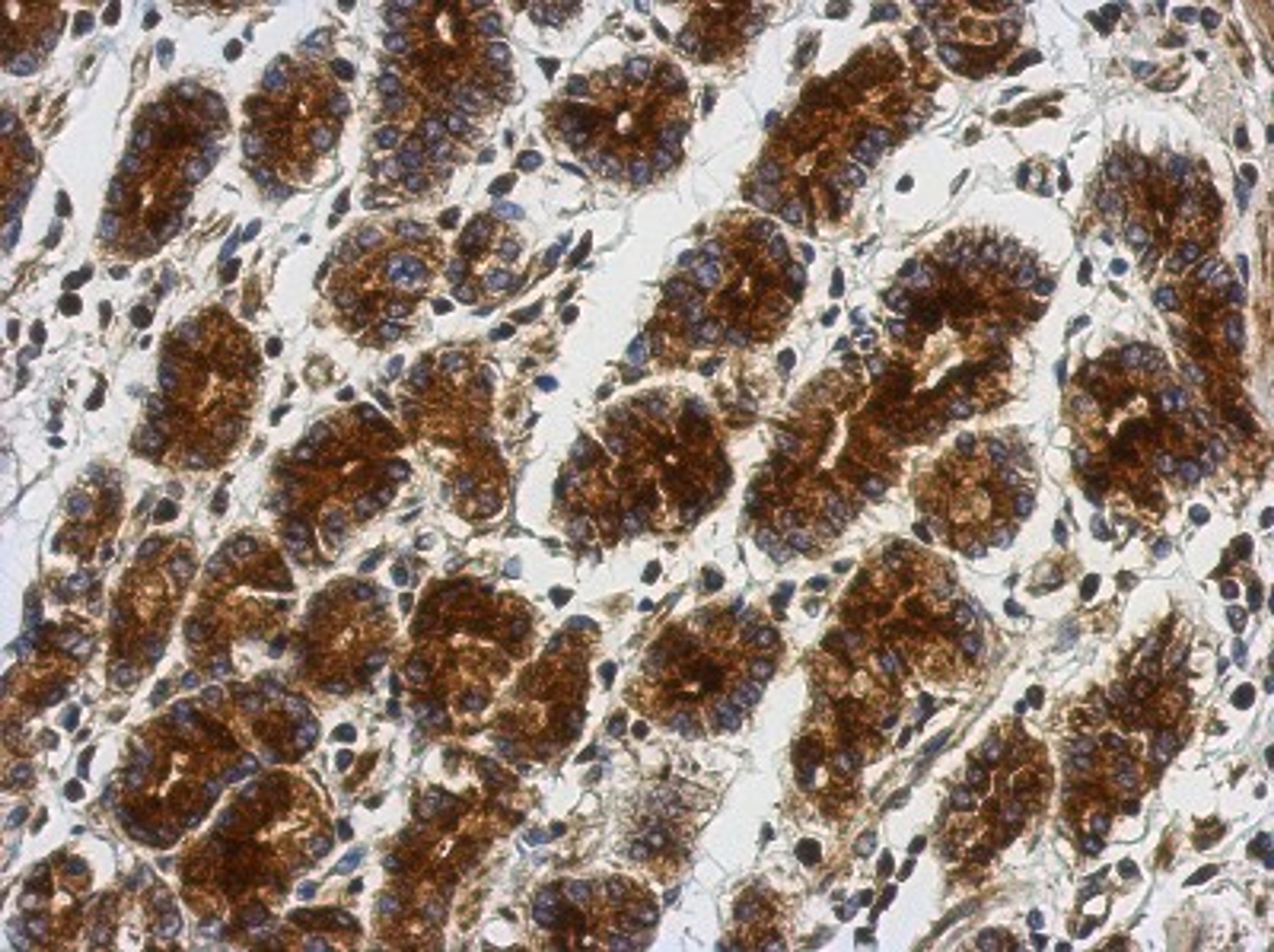 Immunohistochemistry-Paraffin: OMD Antibody [NBP2-19626] - Immunohistochemical analysis of paraffin-embedded Colon ca, using antibody at 1:500 dilution.