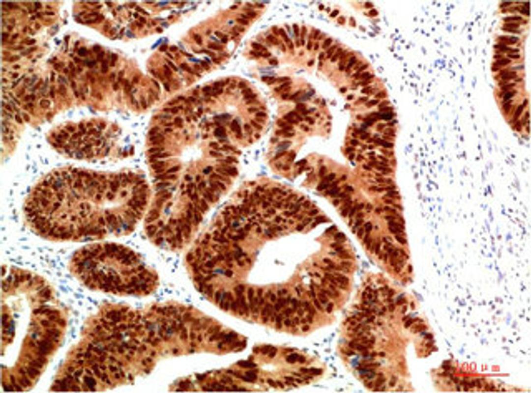 Immunohistochemical analysis of paraffin-embedded Human Colon Carcinoma Tissue using HSP40 Rabbit pAb diluted at 1:200