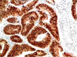 Immunohistochemical analysis of paraffin-embedded Human Colon Carcinoma Tissue using HSP40 Rabbit pAb diluted at 1:200