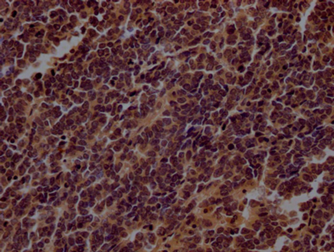 IHC image of CSB-RA798840A0HU diluted at 1:100 and staining in paraffin-embedded human lung cancer performed on a Leica BondTM system. After dewaxing and hydration, antigen retrieval was mediated by high pressure in a citrate buffer (pH 6.0). Section was blocked with 10% normal goat serum 30min at RT. Then primary antibody (1% BSA) was incubated at 4℃ overnight. The primary is detected by a Goat anti-rabbit IgG polymer labeled by HRP and visualized using 0.05% DAB.
