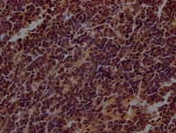 IHC image of CSB-RA798840A0HU diluted at 1:100 and staining in paraffin-embedded human lung cancer performed on a Leica BondTM system. After dewaxing and hydration, antigen retrieval was mediated by high pressure in a citrate buffer (pH 6.0). Section was blocked with 10% normal goat serum 30min at RT. Then primary antibody (1% BSA) was incubated at 4℃ overnight. The primary is detected by a Goat anti-rabbit IgG polymer labeled by HRP and visualized using 0.05% DAB.