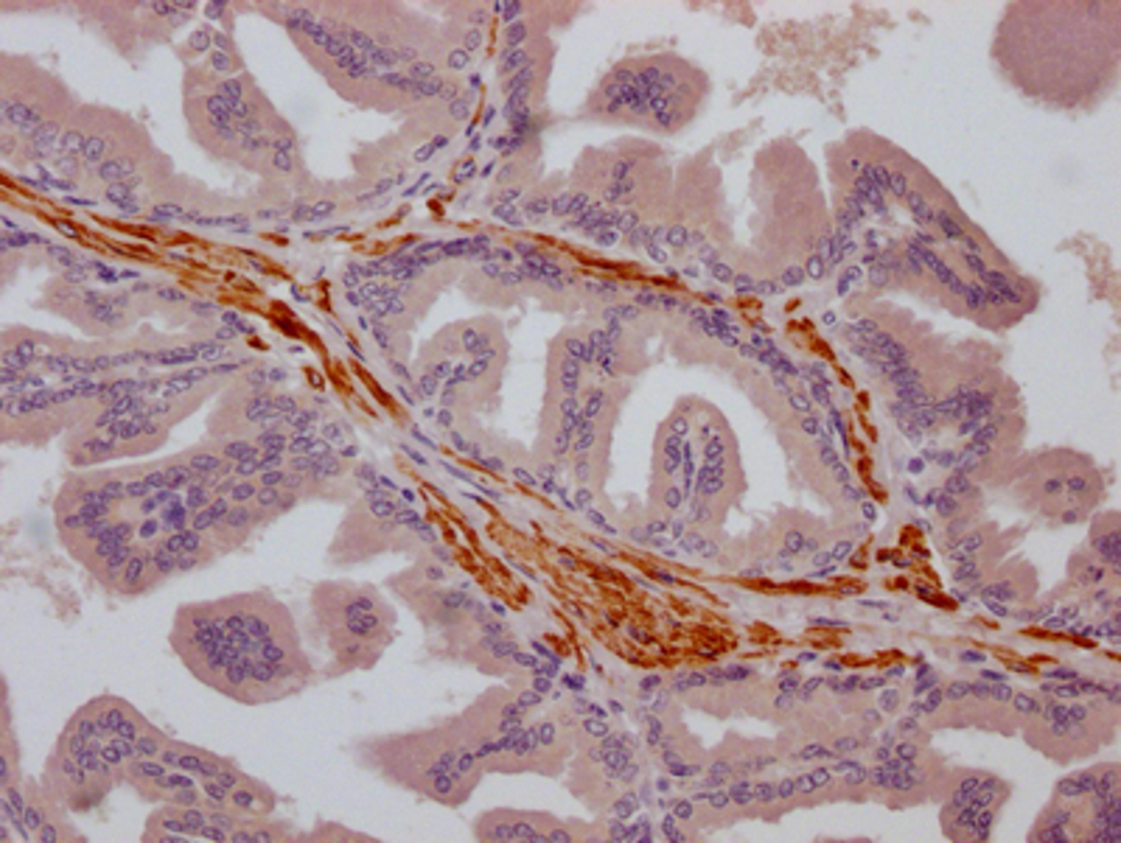 IHC image of CSB-RA186773A0HU diluted at 1:100 and staining in paraffin-embedded human prostate cancer performed on a Leica BondTM system. After dewaxing and hydration, antigen retrieval was mediated by high pressure in a citrate buffer (pH 6.0). Section was blocked with 10% normal goat serum 30min at RT. Then primary antibody (1% BSA) was incubated at 4℃ overnight. The primary is detected by a Goat anti-rabbit IgG polymer labeled by HRP and visualized using 0.05% DAB.