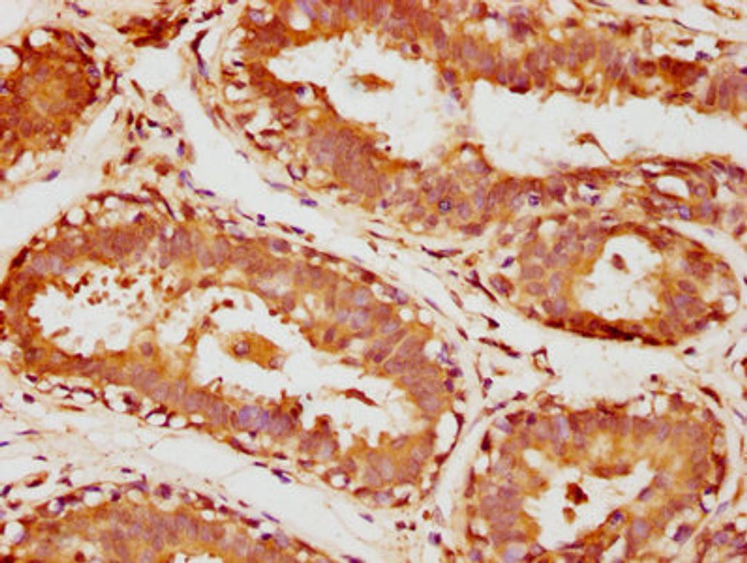 IHC image of CSB-PA00887A0Rb diluted at 1:1000 and staining in paraffin-embedded human breast cancer performed on a Leica BondTM system. After dewaxing and hydration, antigen retrieval was mediated by high pressure in a citrate buffer (pH 6.0). Section was blocked with 10% normal goat serum 30min at RT. Then primary antibody (1% BSA) was incubated at 4&deg;C overnight. The primary is detected by a biotinylated secondary antibody and visualized using an HRP conjugated SP system.