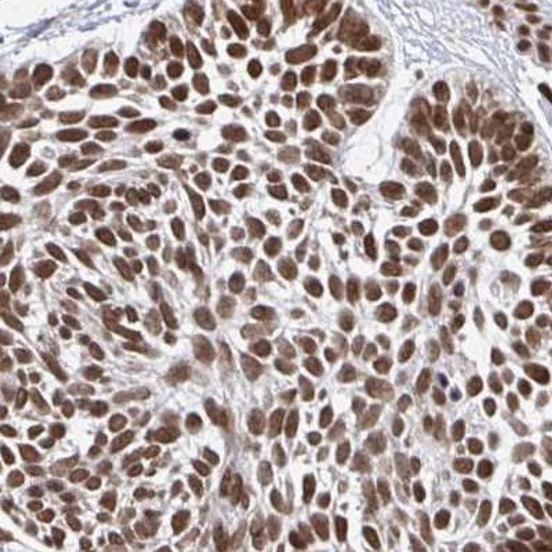 Immunohistochemistry: GTF3C6 Antibody [NBP2-31851] - skin cancer