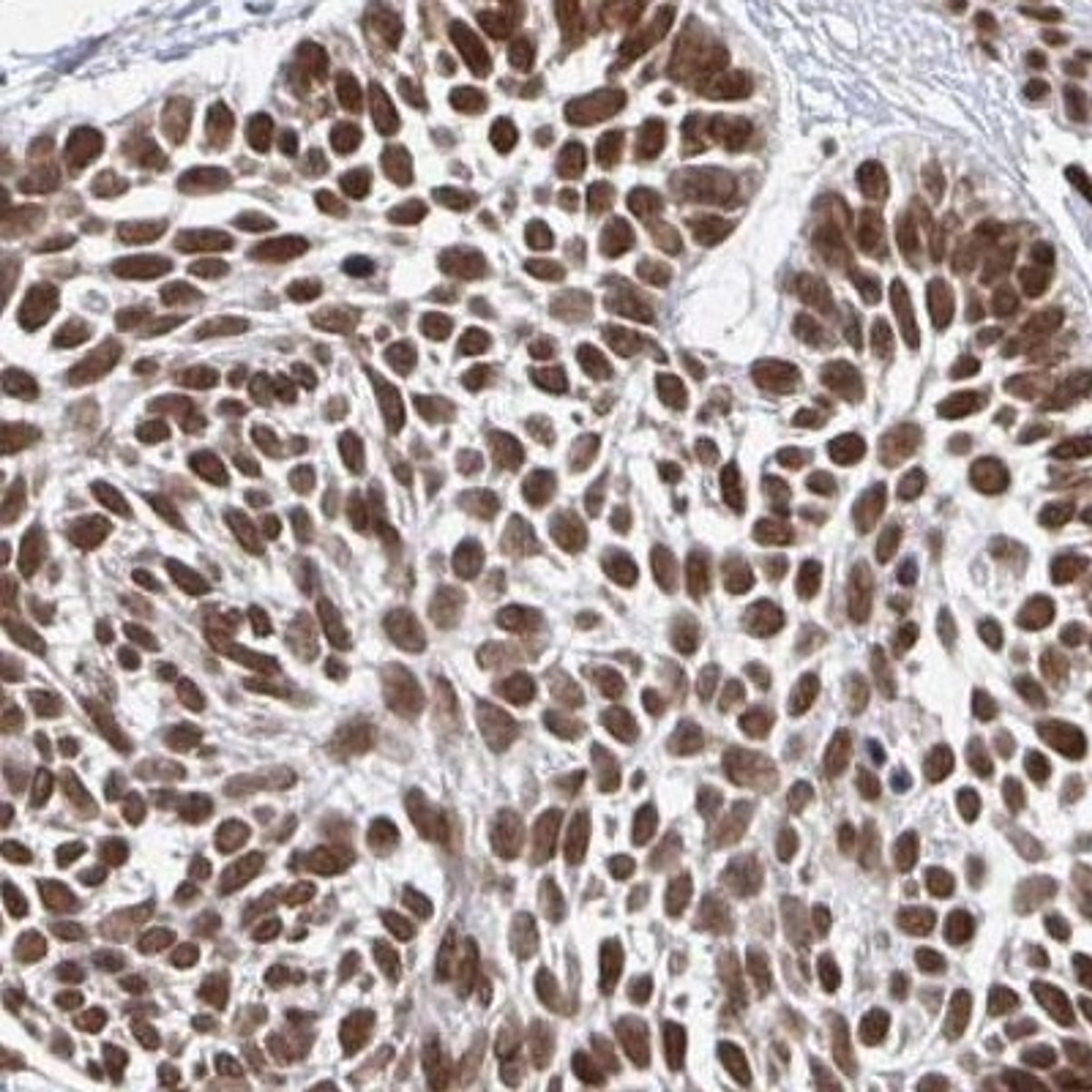 Immunohistochemistry: GTF3C6 Antibody [NBP2-31851] - skin cancer