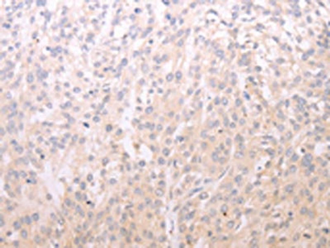 The image on the left is immunohistochemistry of paraffin-embedded Human esophagus cancer tissue using CSB-PA562872(ADIPOR1 Antibody) at dilution 1/20, on the right is treated with fusion protein. (Original magnification: X200)