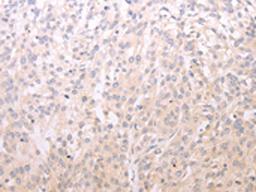 The image on the left is immunohistochemistry of paraffin-embedded Human esophagus cancer tissue using CSB-PA562872(ADIPOR1 Antibody) at dilution 1/20, on the right is treated with fusion protein. (Original magnification: X200)