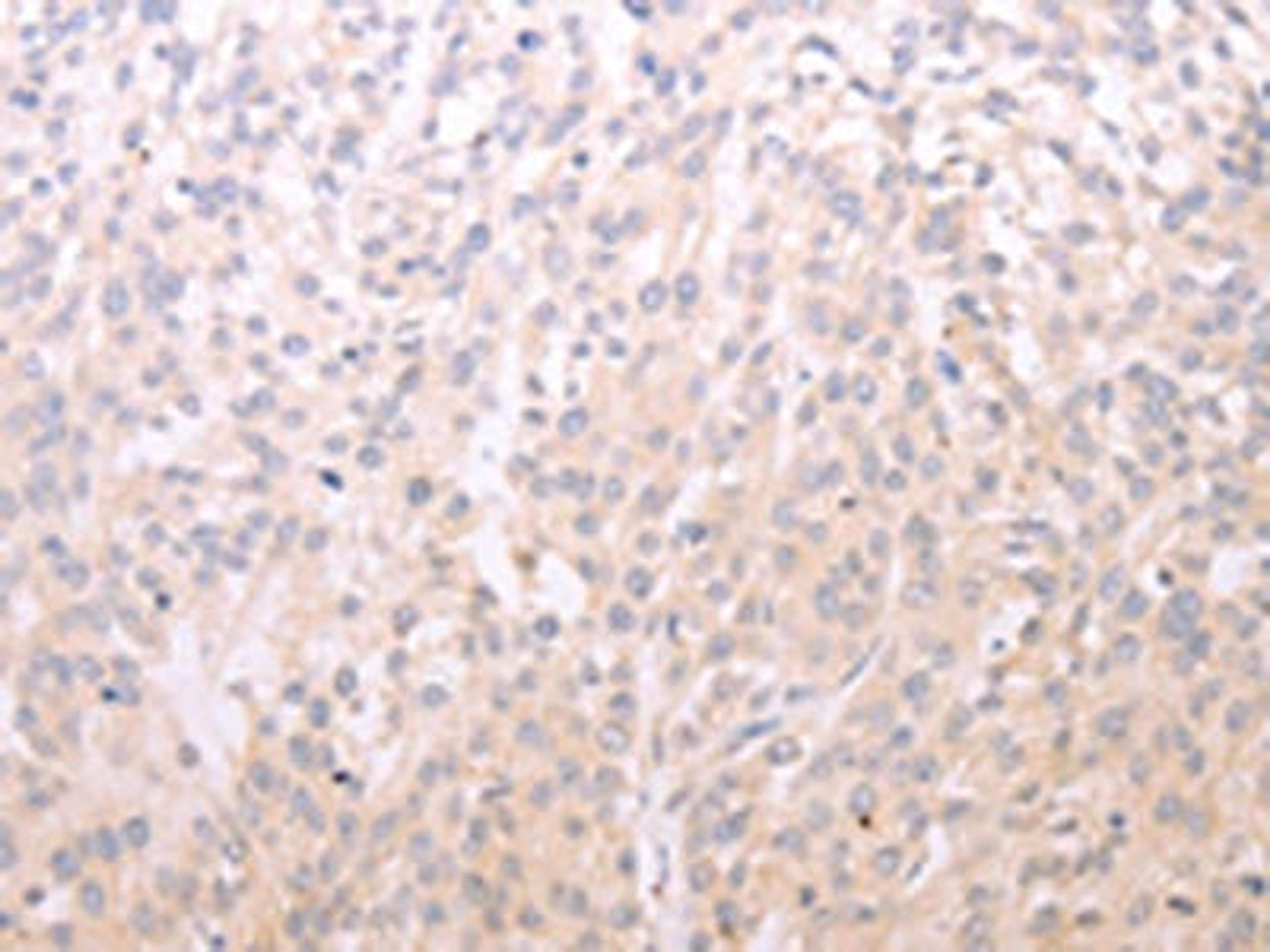 The image on the left is immunohistochemistry of paraffin-embedded Human esophagus cancer tissue using CSB-PA562872(ADIPOR1 Antibody) at dilution 1/20, on the right is treated with fusion protein. (Original magnification: X200)