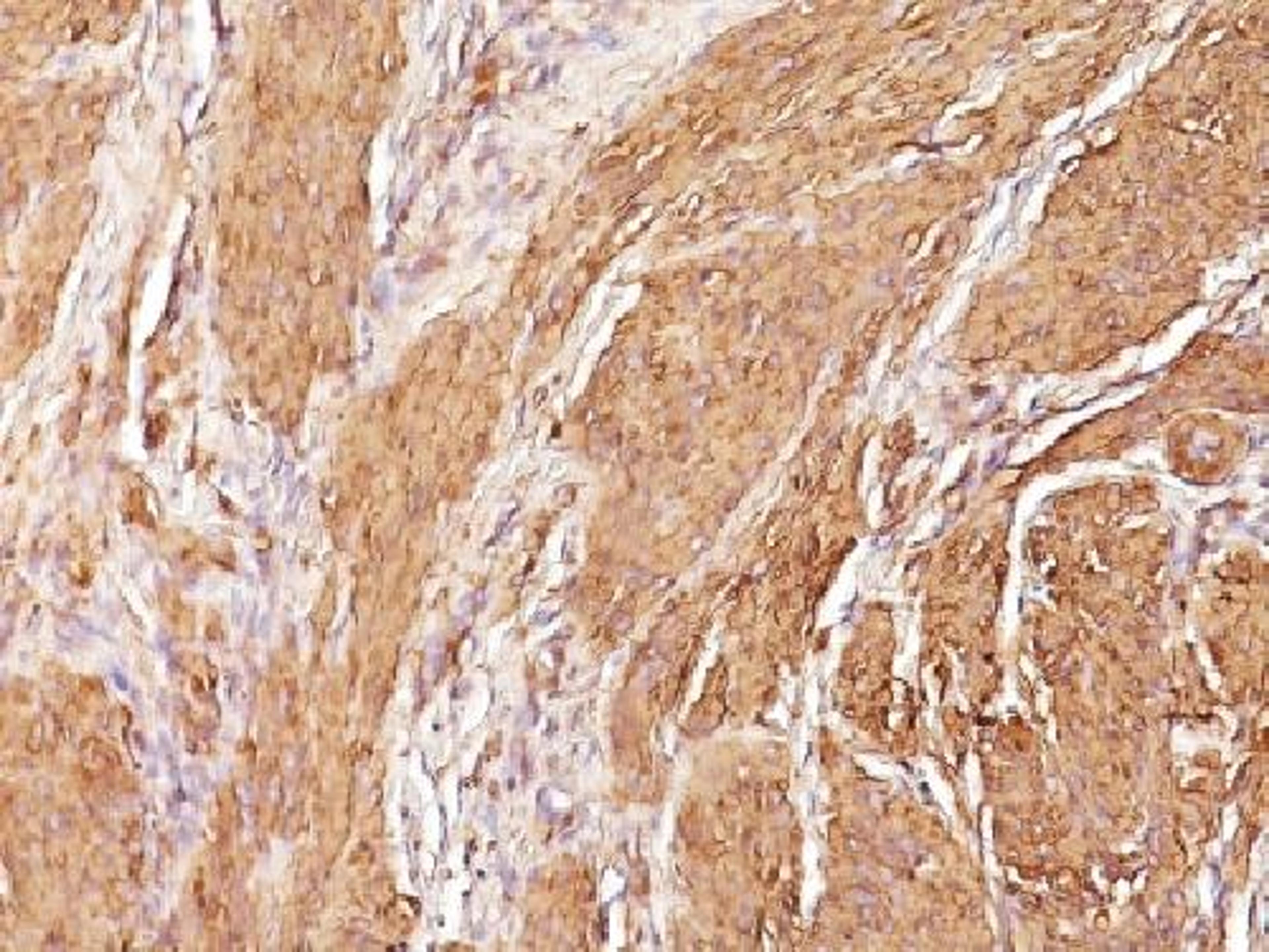 Immunohistochemical staining of human Leiomyosarcoma tissue using Muscle Specific antibody