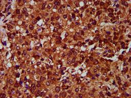 IHC image of CSB-PA007649LA01HU diluted at 1:400 and staining in paraffin-embedded human glioma performed on a Leica BondTM system. After dewaxing and hydration, antigen retrieval was mediated by high pressure in a citrate buffer (pH 6.0). Section was blocked with 10% normal goat serum 30min at RT. Then primary antibody (1% BSA) was incubated at 4&deg;C overnight. The primary is detected by a biotinylated secondary antibody and visualized using an HRP conjugated SP system.