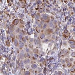 Immunohistochemistry: CACNG3 Antibody [NBP2-31738] - melanoma