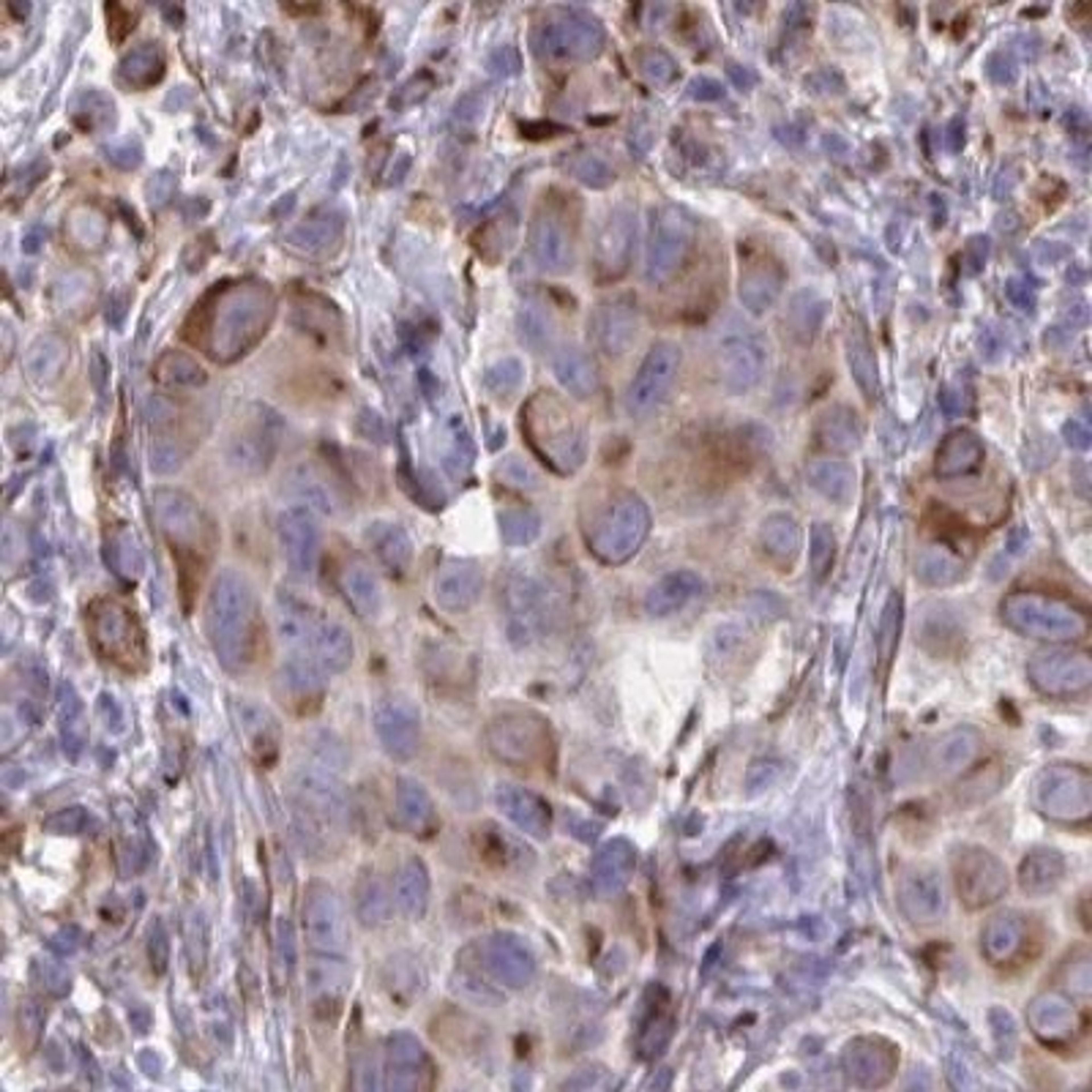 Immunohistochemistry: CACNG3 Antibody [NBP2-31738] - melanoma