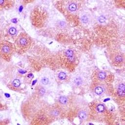 Immunohistochemical staining of human liver cancer tissue using FURIN antibody