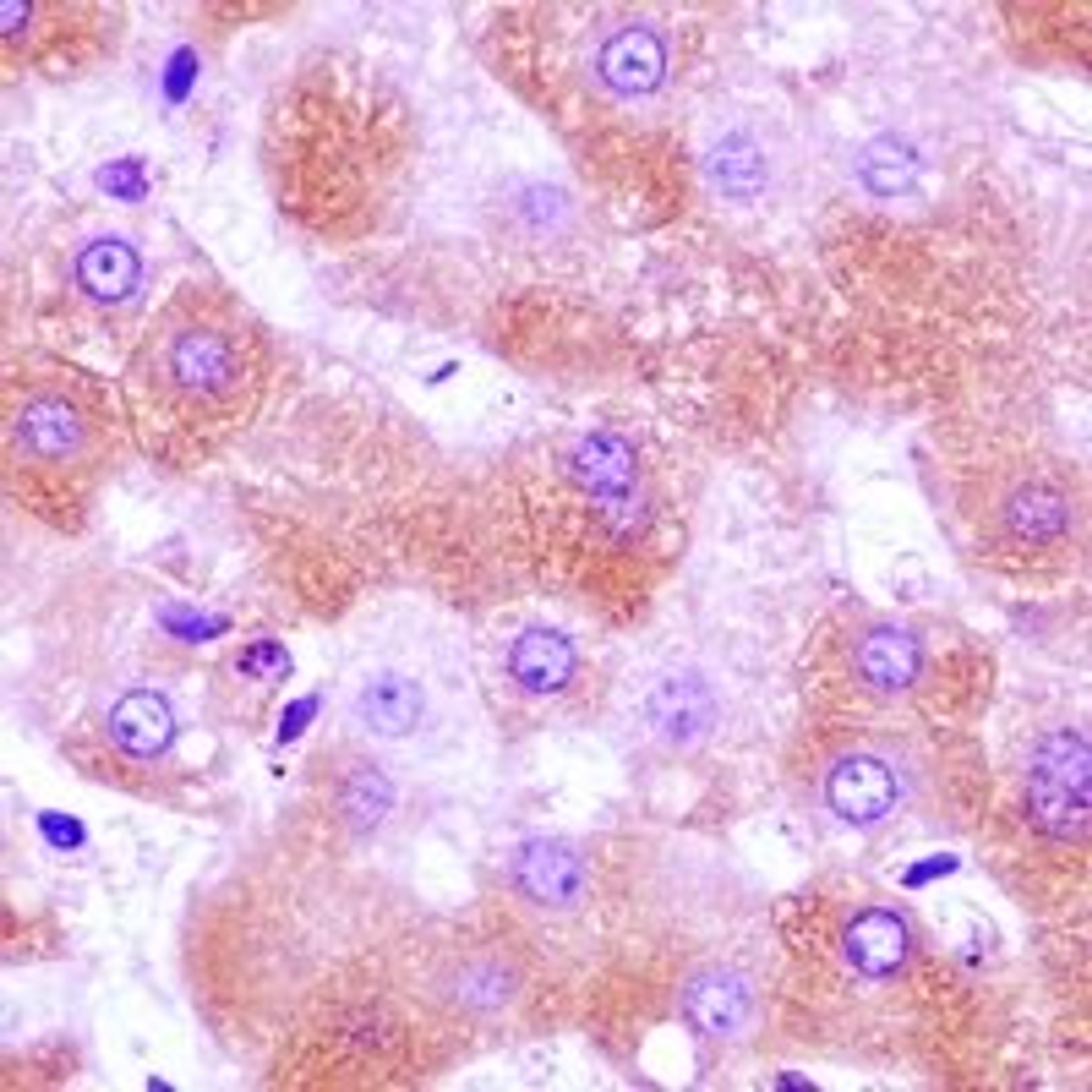 Immunohistochemical staining of human liver cancer tissue using FURIN antibody