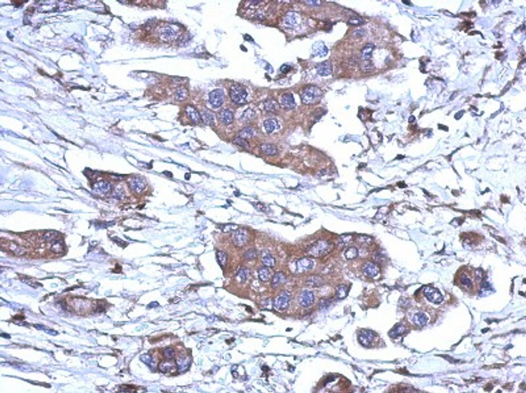 Immunohistochemistry-Paraffin: RNase H1 Antibody [NBP2-20171] - Immunohistochemical analysis of paraffin-embedded Breast ca, using antibody at 1:500 dilution.