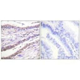 Immunohistochemical analysis of paraffin-embedded human lung carcinoma tissue using Cyclin A antibody.