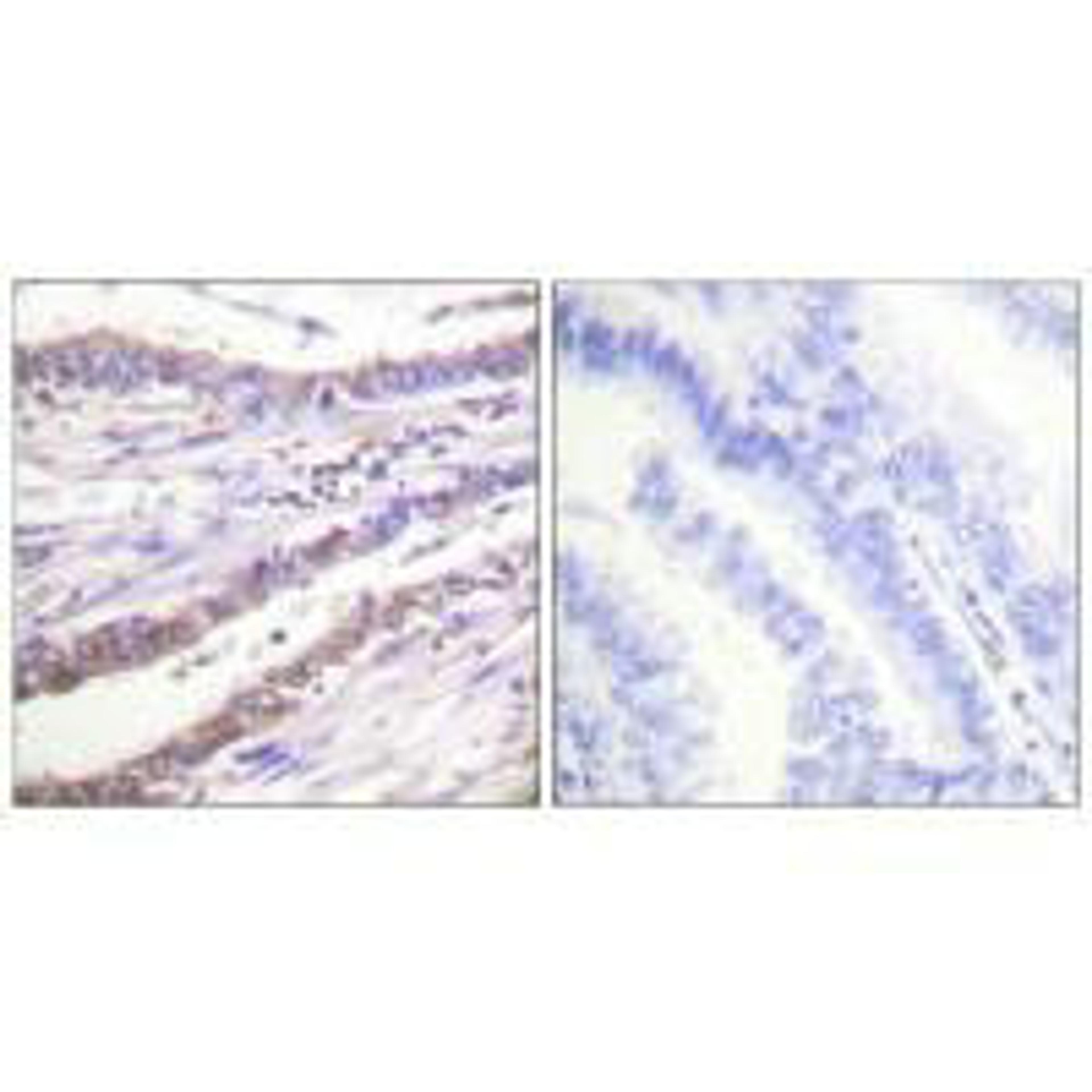 Immunohistochemical analysis of paraffin-embedded human lung carcinoma tissue using Cyclin A antibody.