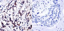 Immunohistochemistry-Paraffin: TIMP-1 Antibody (F31 P2 A5) [NB100-74551] - Cancer biopsies of deparaffinized Human breast carcinoma tissue at a dilution of 1:20.