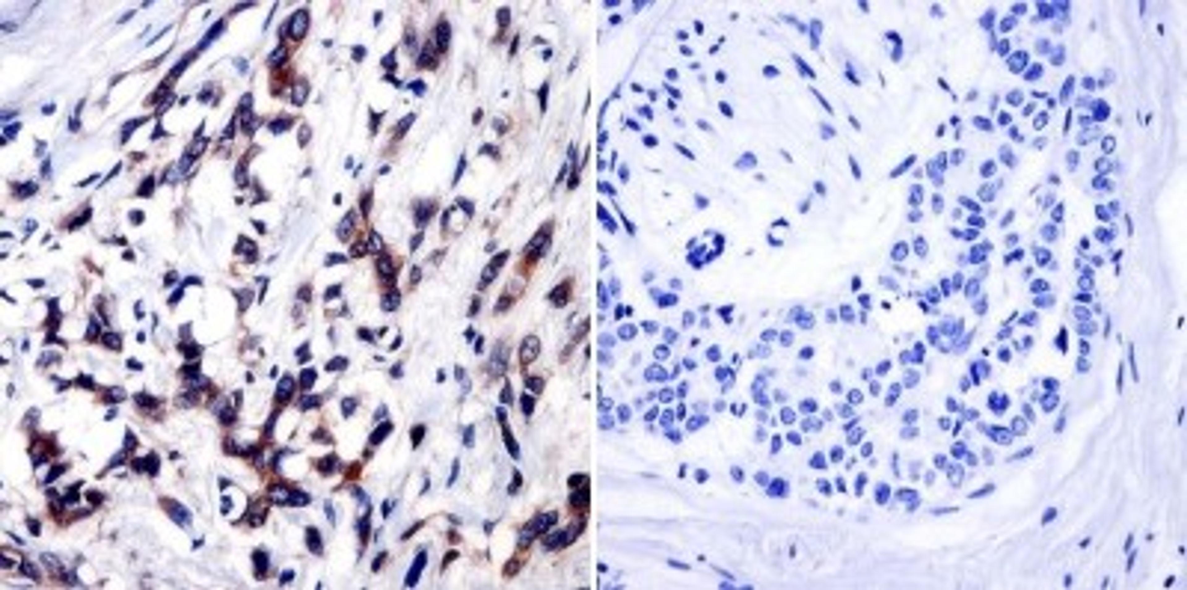 Immunohistochemistry-Paraffin: TIMP-1 Antibody (F31 P2 A5) [NB100-74551] - Cancer biopsies of deparaffinized Human breast carcinoma tissue at a dilution of 1:20.